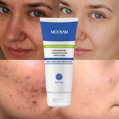 Salicylic Anti Acne Remover Facial Cleansing